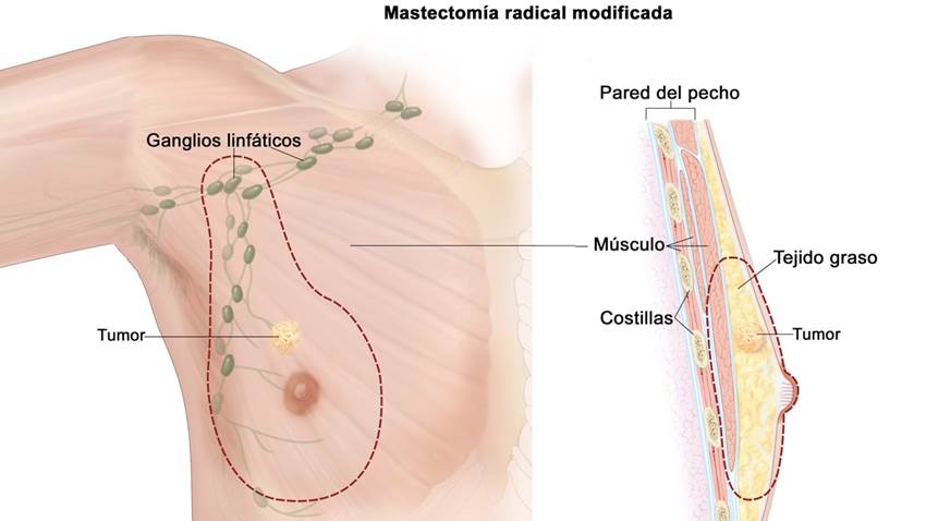 Estímulo hormonal de estrógeno en los hombres aumentaría riesgo de cáncer de mama
