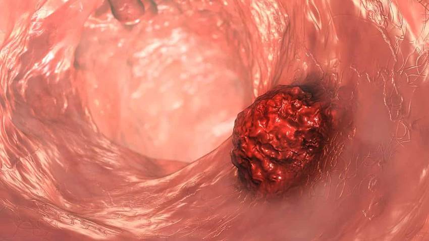 ¿Qué es la materia oscura de los alimentos y por qué puede ayudar en la prevención del Cáncer?
