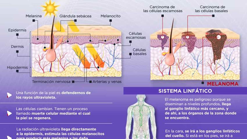 ¿Cómo se forma un melanoma? - Infografía