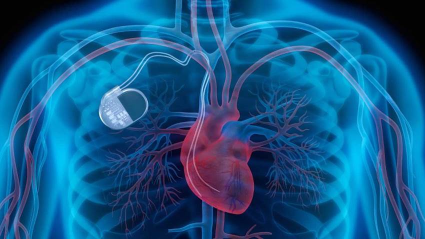 Realizan primera implantación de dispositivo cardíaco intracorpóreo en menor de 12 años