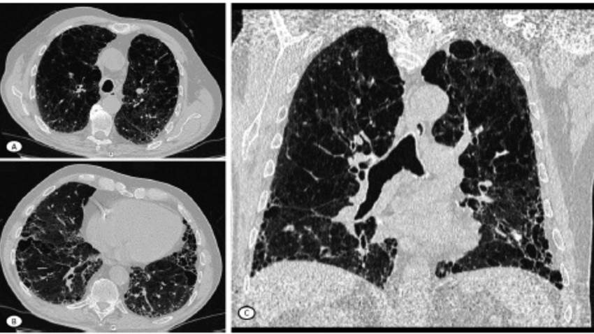 La neumonía intersticial usual en artritis reumatoide se asocia a mayor mortalidad