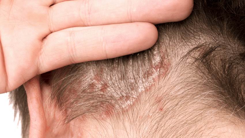Psoriasis del cuero cabelludo: síntomas, causas y tratamiento