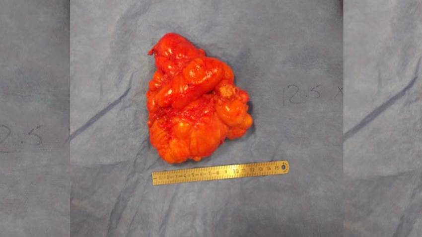 Detectan lipoma en glúteo de paciente puertorriqueña de 15 años