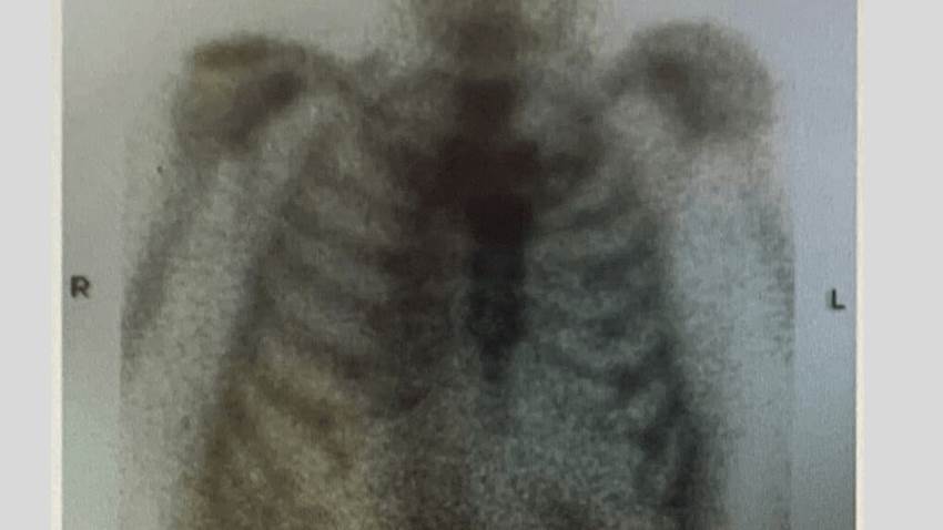 Hallan rara complicación de artritis séptica y osteomielitis en articulación del esternón en Puerto Rico