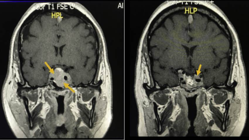 Puerto Rico registra el tercer caso de paciente que desarrolló doble tumor de pituitaria plurihormonal