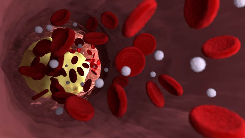 Describen raro diagnóstico de hipercalcemia en paciente con hipoparatiroidismo