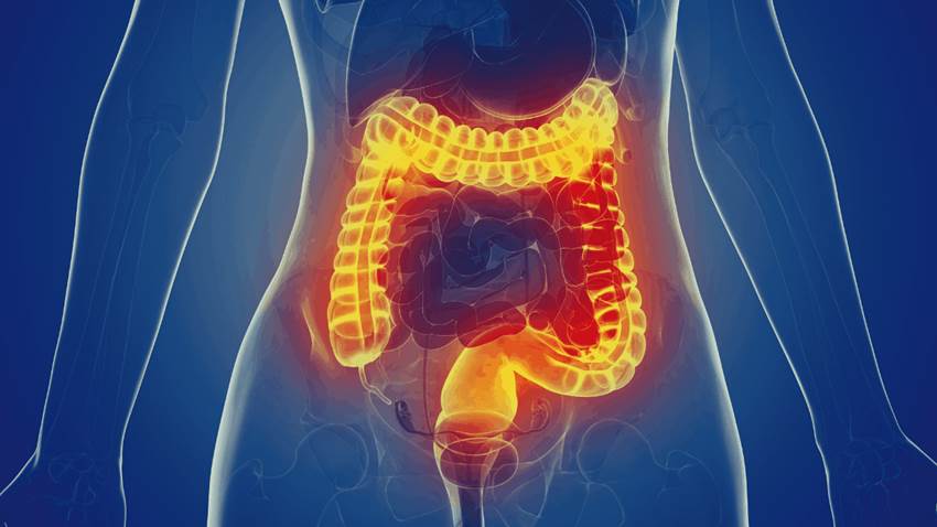 La mala absorción de carbohidratos elevaría el riesgo de síndrome de intestino irritable