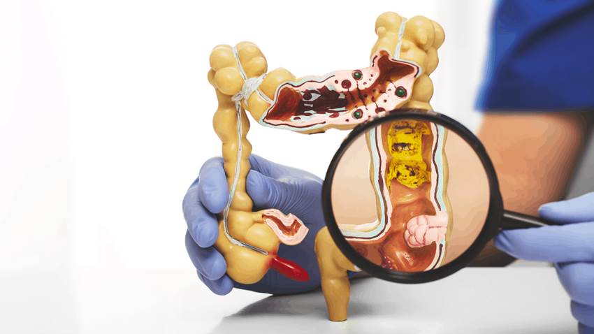 Buscan alternativa paliativas en beneficio de los pacientes con colitis en Puerto Rico