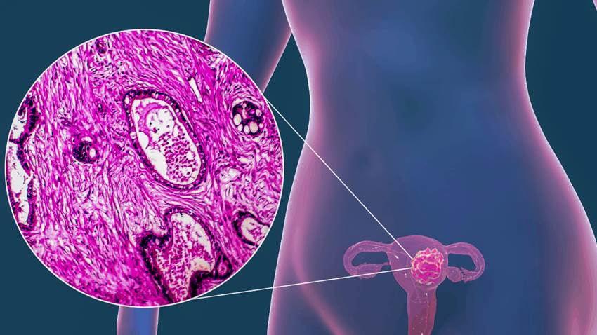 Cáncer cervicouterino incipiente: los desenlaces con la cirugía mínimamente invasiva son peores
