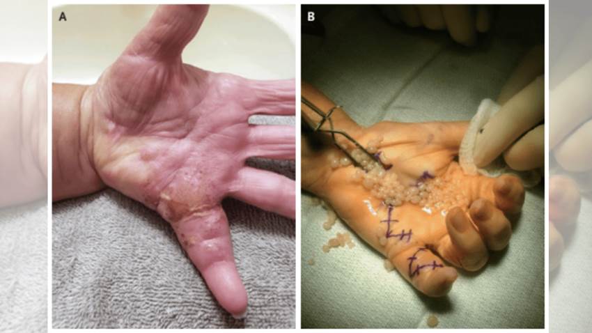 Artritis psoriásica provoca en paciente formaciones con apariencia de granos de arroz