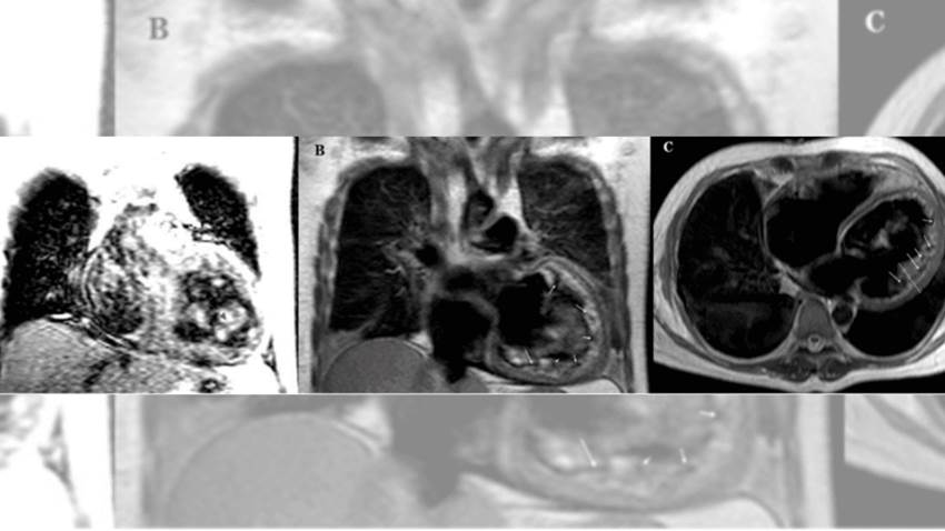 Necesario el diagnóstico oportuno de las miocardiopatías congénitas