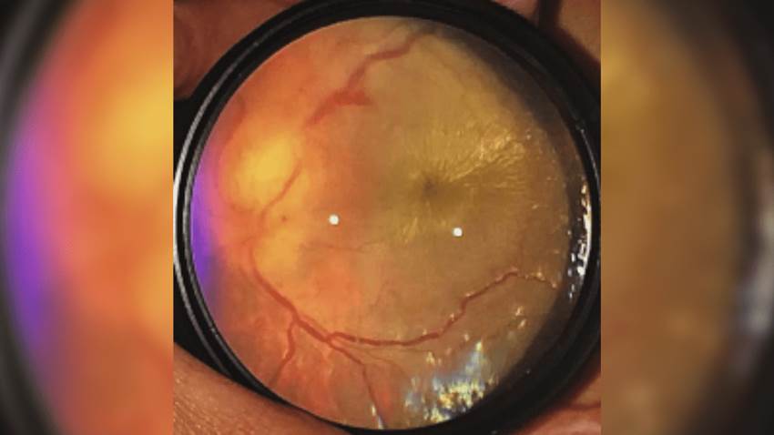 Arañazo de gato provoca neurorretinitis en paciente pediátrico