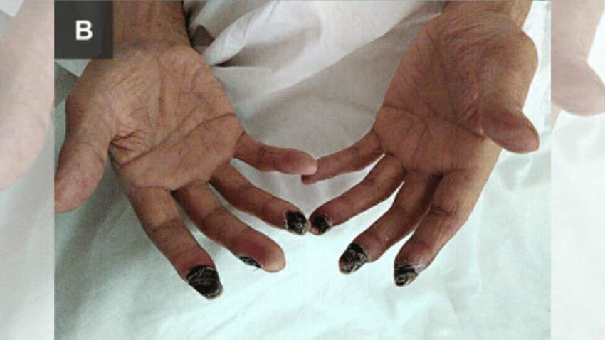 Paciente de cáncer de pulmón desarrolló síndrome de Raynaud con evolución a gangrena
