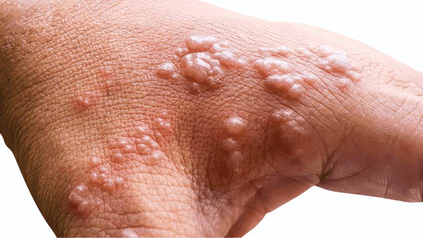 ¿Qué es la neuralgia posherpética y por qué es una dolorosa complicación del herpes zóster?
