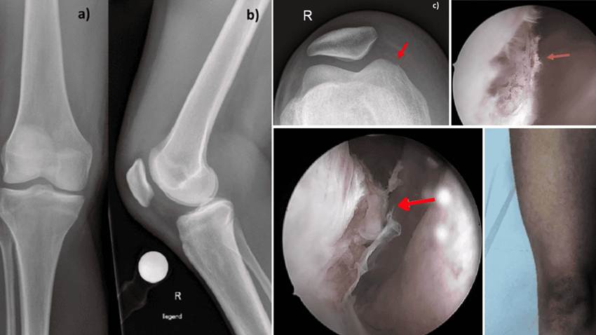 Mujer desarrolla artritis séptica con infección articular por Enterococcus faecium tras picotazo de gallo