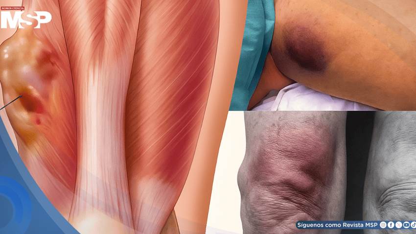 Sarcomas: el cáncer que con frecuencia se confunde con un golpe o una lesión común y avanza en silencio