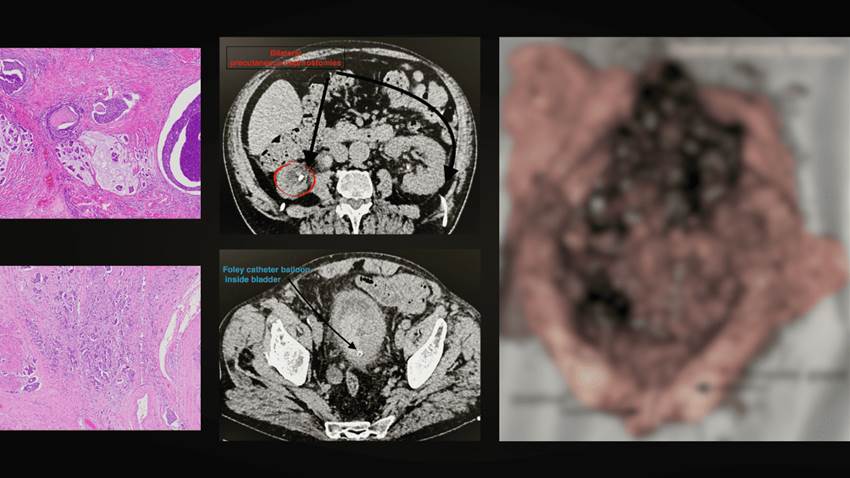Paciente de 89 años desarrolla peritonitis química por filtración urinaria secundaria a cáncer vesical