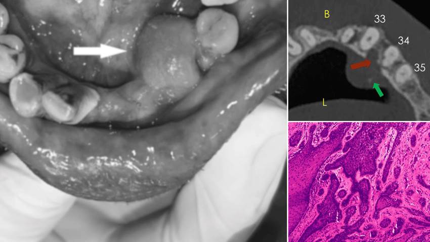 Describen caso de ameloblastoma que simulaba hiperplasia gingival, localizado en mandíbula inflamada