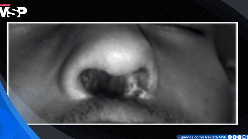 Paciente con VIH sin tratamiento sufre dolor dental y destrucción del tabique por delirio de parasitosis