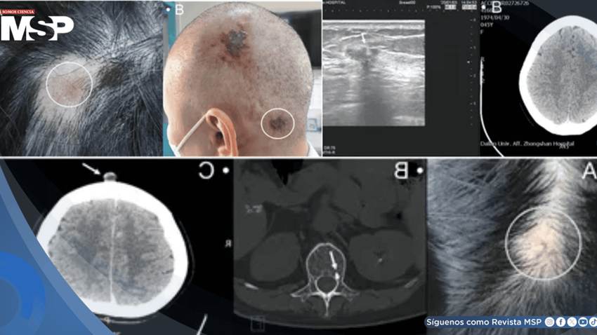 Detectan metástasis en cuero cabelludo como primera señal en dos mujeres con cáncer de mama avanzado