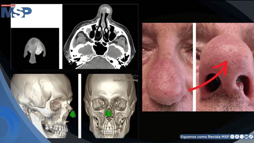 Detectan en hombre con gota crónica un bulto nasal causado por acumulación de cristales de ácido úrico
