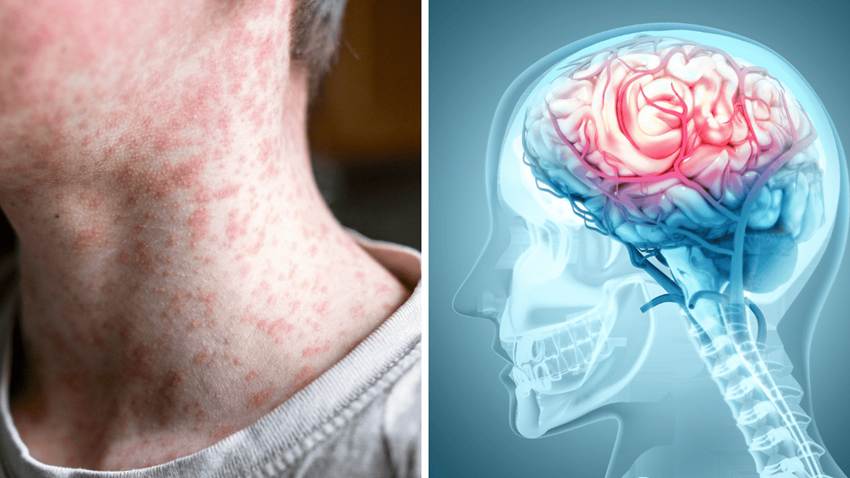 1 de cada 1,000 niños con sarampión puede desarrollar encefalitis, provocando daño cerebral irreversible