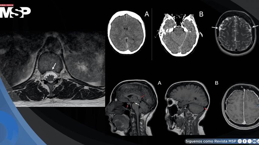 Hipotensión intracraneal y cefalea ortostática causó sangrado cerebral y fuga de líquido cefalorraquídeo