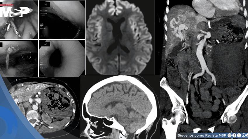 Hemorragia gastrointestinal provocó edema cerebral en paciente con Telangiectasia y malformación hepática