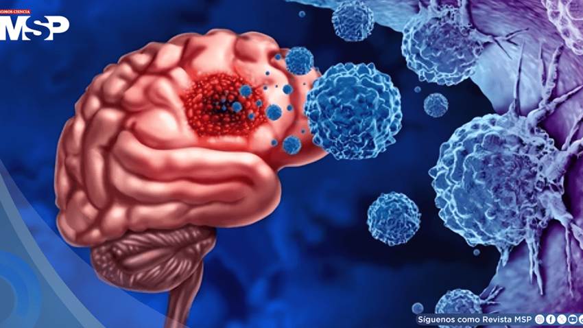 Parche postquirúrgico reduciría la recurrencia del glioblastoma: ataca el 90% de células tumorales