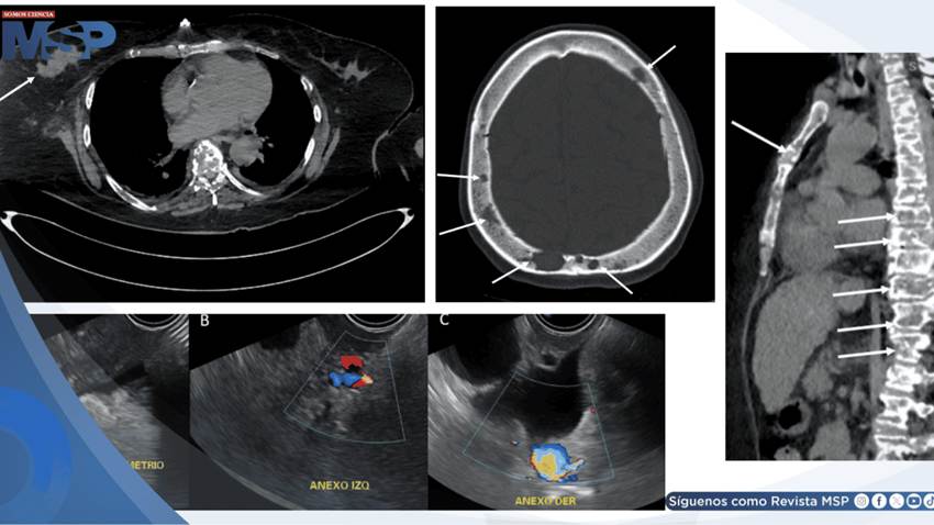 Pancreatitis aguda como presentación inicial de cáncer de mama metastásico debido a hipercalcemia maligna