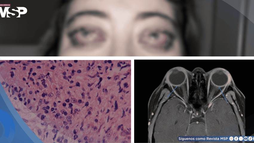 Escleritis con parálisis facial e hipertensión intracraneal como presentación de leucemia eosinofílica