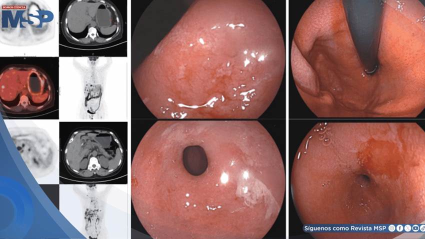 Cáncer pulmonar tratado con pembrolizumab provocó gastritis; al suspenderlo, metastatizó a hígado y hueso