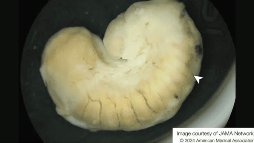 Hallan larva pálida en ojo de paciente que habría consumido carne de cocodrilo contaminada