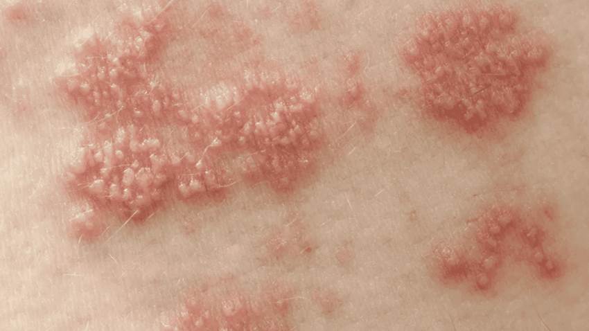 EE.UU incluye el herpes en su Plan Nacional contra las ITS para mejorar la prevención y tratamiento