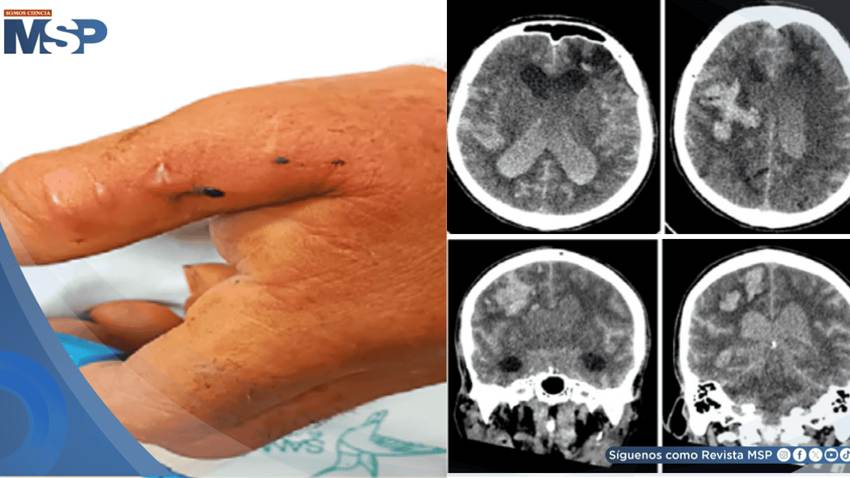 Mordedura de serpiente mapaná desencadena hemorragia intracerebral mortal en paciente adulto mayor