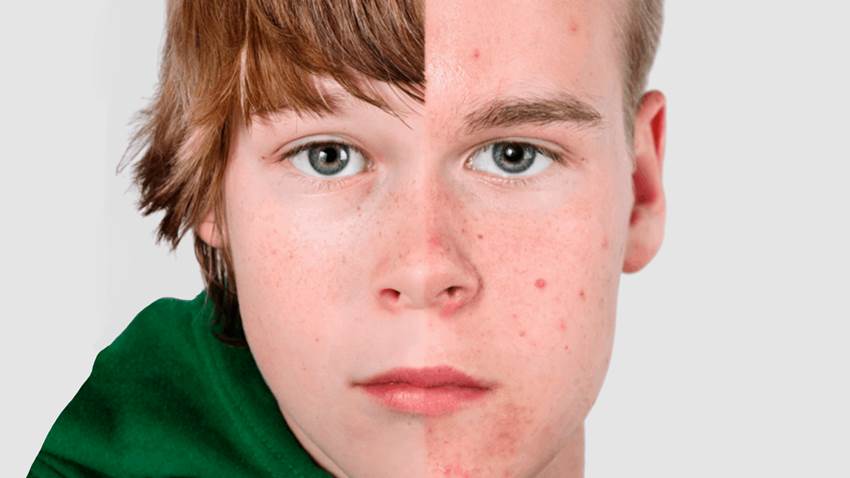 Factores que contribuyen con la pubertad precoz