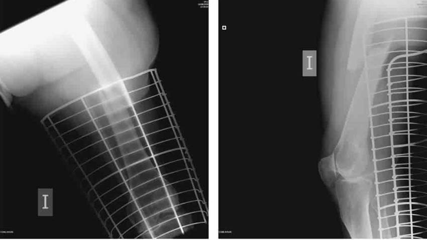 Se necesita al menos un año con bisfosfonatos para prevenir fracturas, según estudio