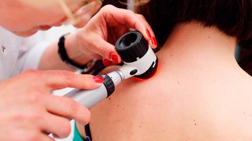 Nueva técnica predice cuáles pacientes con melanoma están en riesgo de metástasis