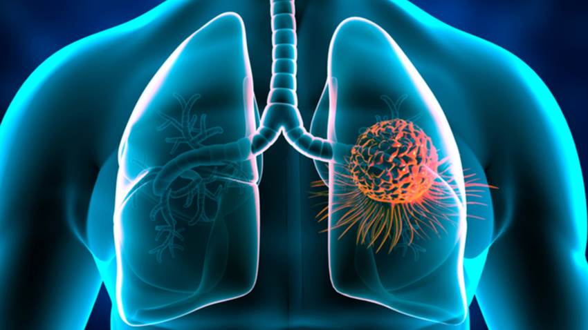 Avances médicos: Terapias biológicas dirigidas al cáncer del pulmón