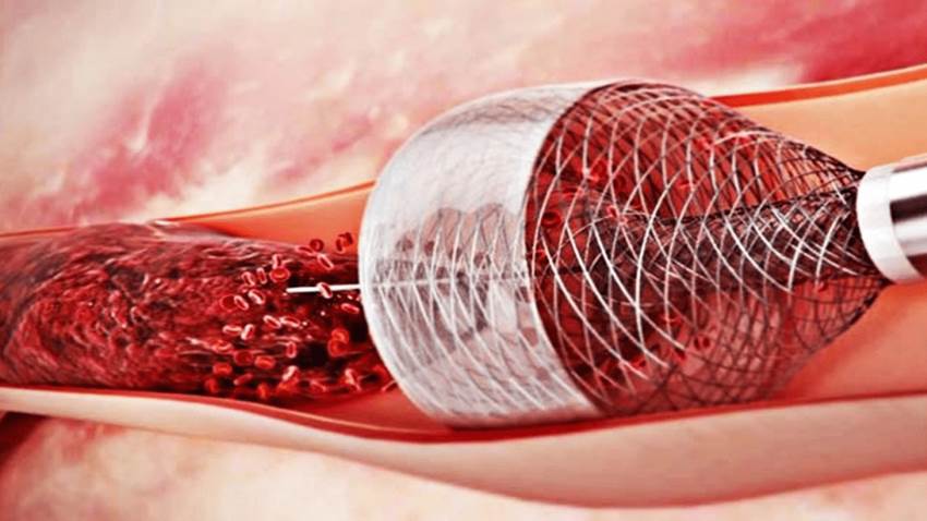 Trombectomía directa por accidente cerebrovascular: ¿qué grupos pueden beneficiarse?