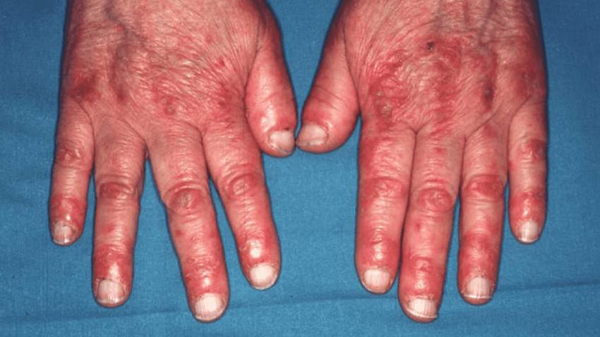 Estudio sostiene alta probabilidad de infarto al miocardio de pacientes con dermatomiositis