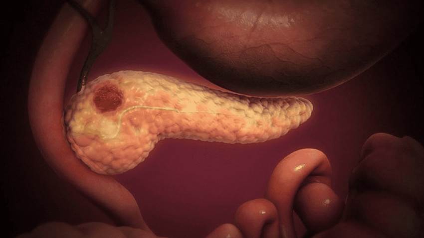 Pacientes con diabetes ¿pueden tener mayor probabilidad de padecer cáncer de páncreas?
