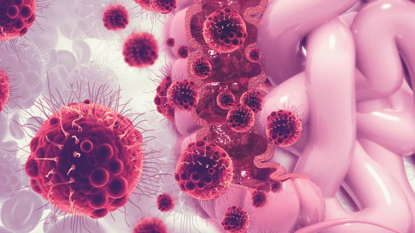 Detección y diagnóstico del cáncer colorrectal: Inteligencia artificial al servicio de la medicina