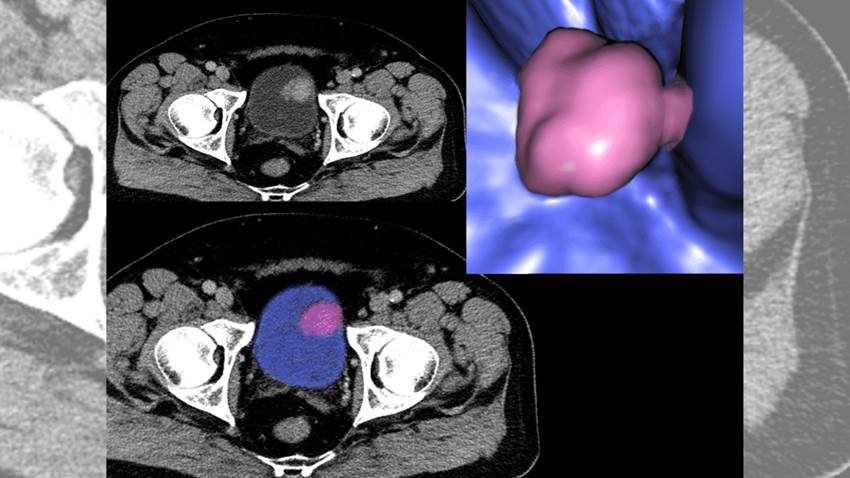 Quimioterapia complementaria mejora supervivencia en pacientes con cáncer de vejiga con invasión muscular