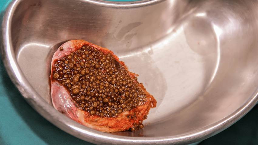 América Latina entre los países con mayor incidencia de cáncer de la vesícula biliar