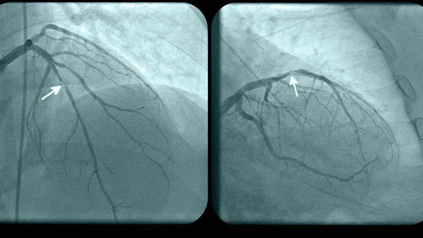 La desnutrición duplica el riesgo de mortalidad en pacientes con insuficiencia cardiaca