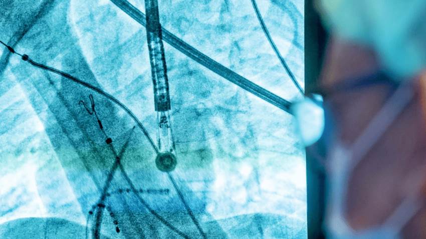 Procedimiento de ablación por catéter puede beneficiar pacientes con sarcoidosis cardíaca, según estudio