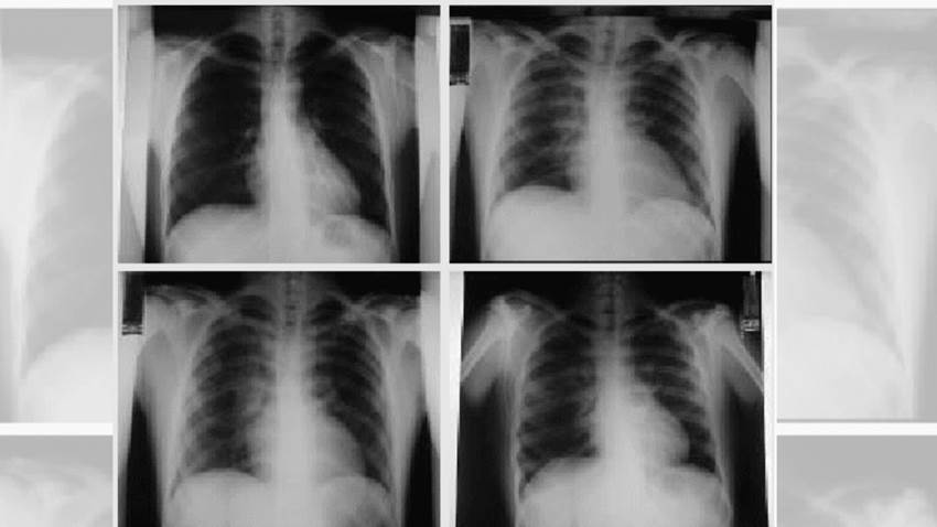 Demuestran beneficio de nitroglicerina en pacientes con edema pulmonar cardiogénico y fallo respiratorio
