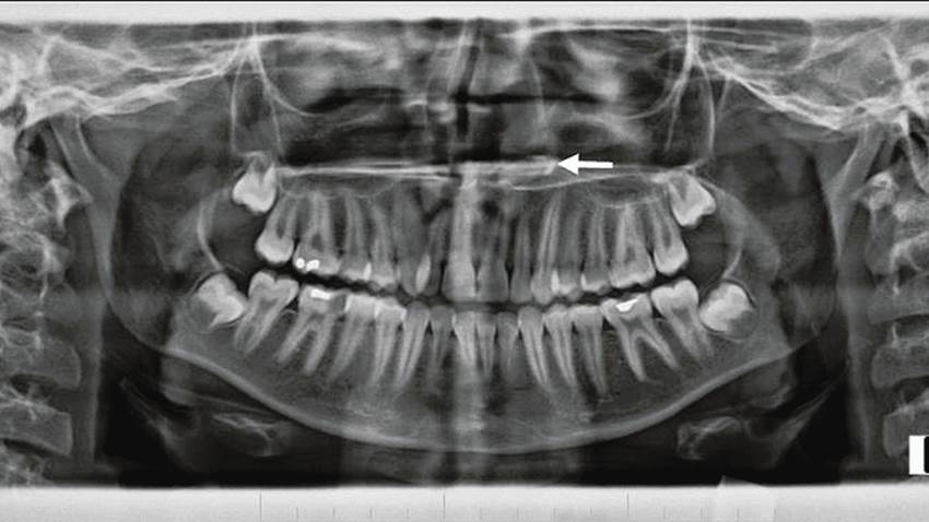 Raro de diente ectópico intranasal en mujer joven se registra en la literatura