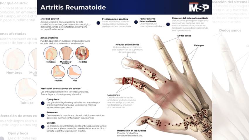 #Especial - Artritis Reumatoide
